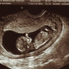 Ultrasound Week 12 Picture