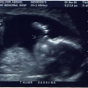 Ultrasound Week 18 Picture